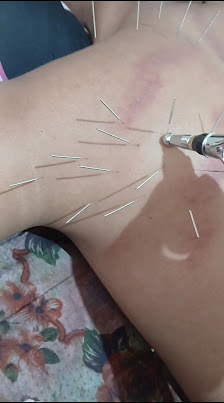 Terapi kretek kretek chiropratic, pijat urut tradisional, massage, bekam, sport MCO, pinggang kejepit