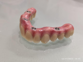 Wonder Dental - Spesialis Implan Gigi Surabaya